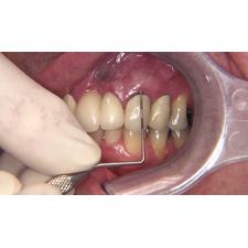 Dr. Christensen's Esthetic Gingival Covering of Exposed Crown Margins DVD, 2nd Edition