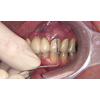 Dr. Christensen's Esthetic Gingival Covering of Exposed Crown Margins DVD, 2nd Edition